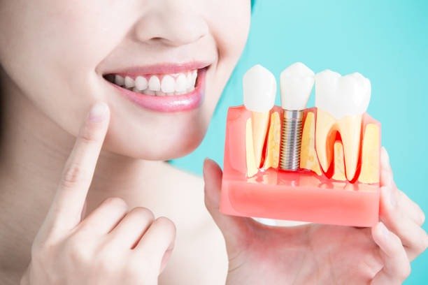Can Anyone Get Dental Implants?