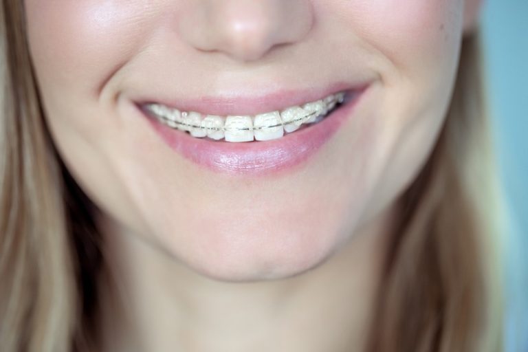 Why Are Translucent Cosmetic Braces a Growing Trend?