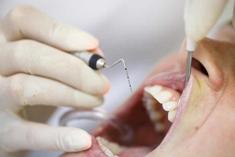 How Do I Know If I Need Periodontal Treatment for My Gums?