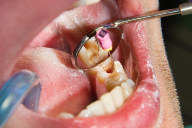 What Are the Top Options for Root Canal Treatment?